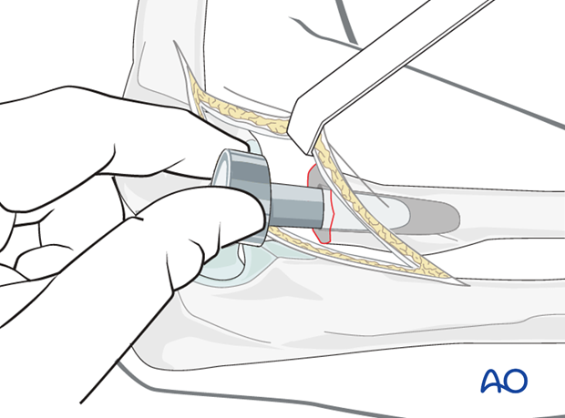 Radial neck replacement arthroplasty – Sizing of prosthesis