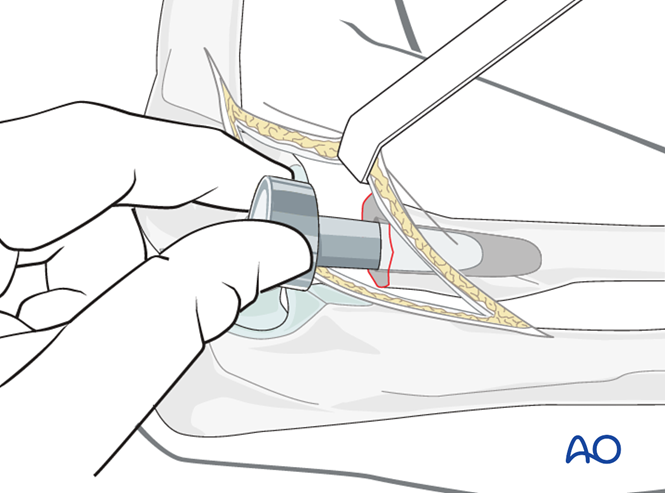 Radial head arthroplasty for Radius, complete articular