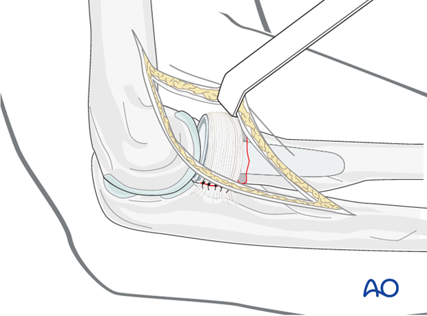 Radial neck replacement arthroplasty – Ligament repair