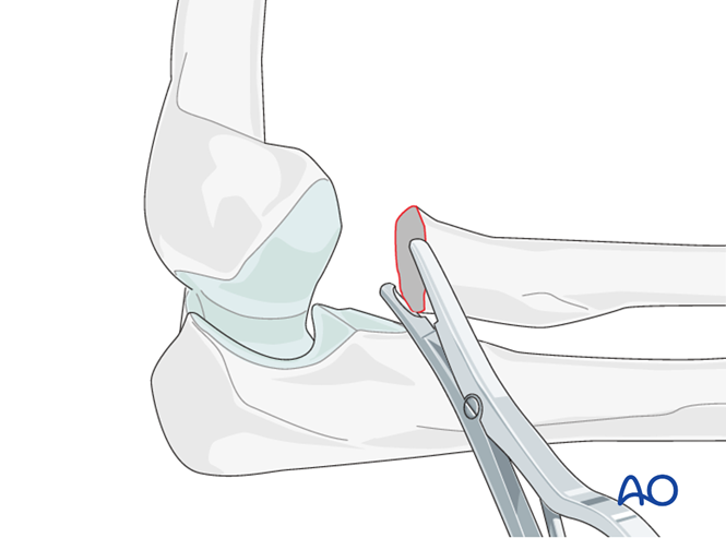 Radial head excision for Radius, partial articular