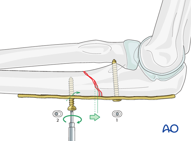 Ulna oblique metaphyseal plate - Compression