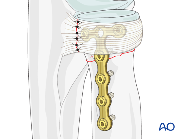 Transverse radial neck – Compression with T-plate