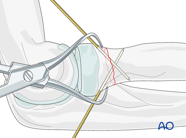 Transverse radial neck – Compression with T-plate – Reduction and temporary fixation