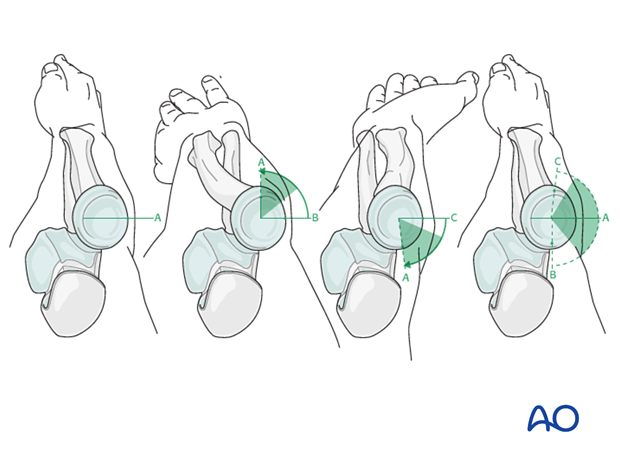 Transverse radial neck – Compression with T-plate – Safe Zones