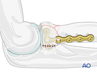 radius complete articular