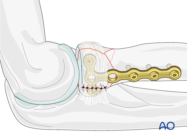 Complete radial head – Lag screw through plate – Repair of annular ligament