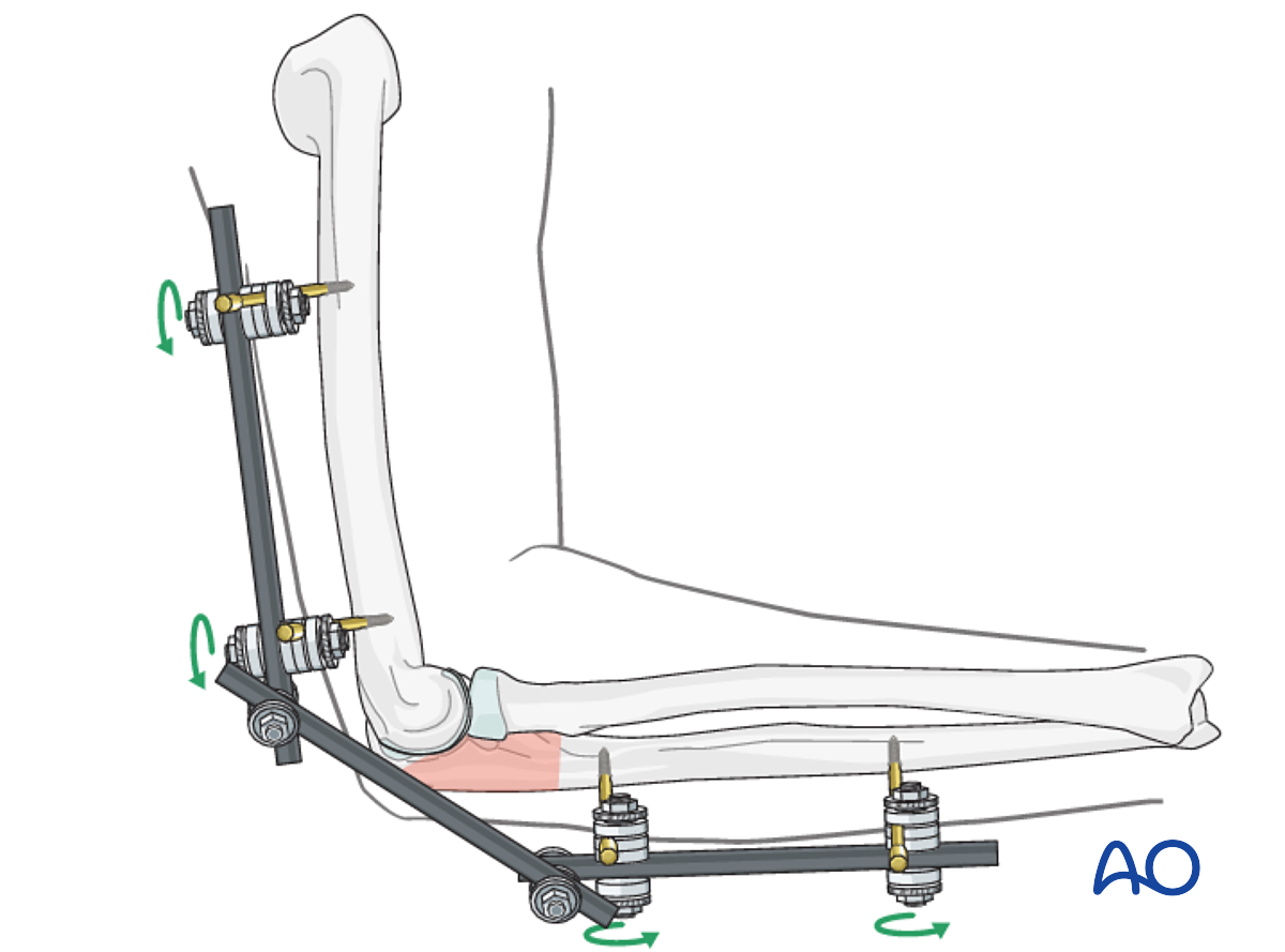 Temporary External Fixation For Ulna, Complete Articular