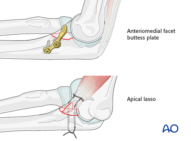 open reduction internal fixation