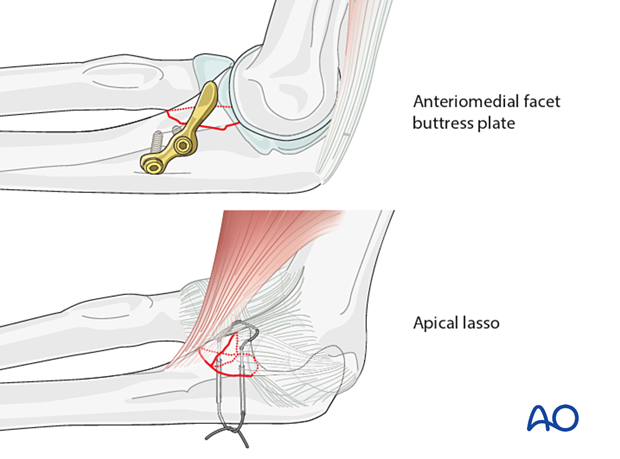 Repair of coronoid fracture