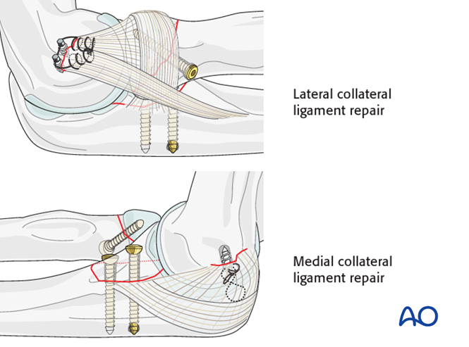 Open reduction internal fixation for Terrible triad