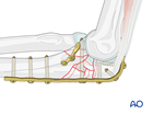 anterior fracture dislocation