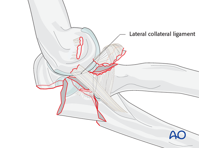 Open reduction internal fixation for Posterior fracture dislocation