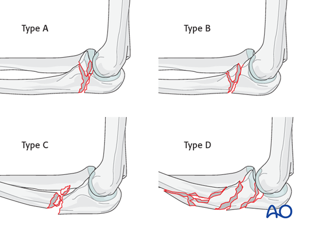 open reduction internal fixation