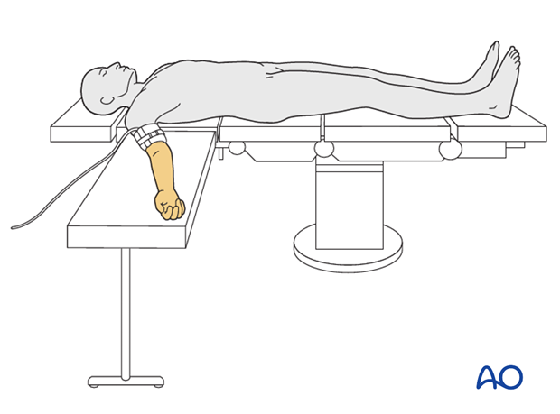 supine for anterior access