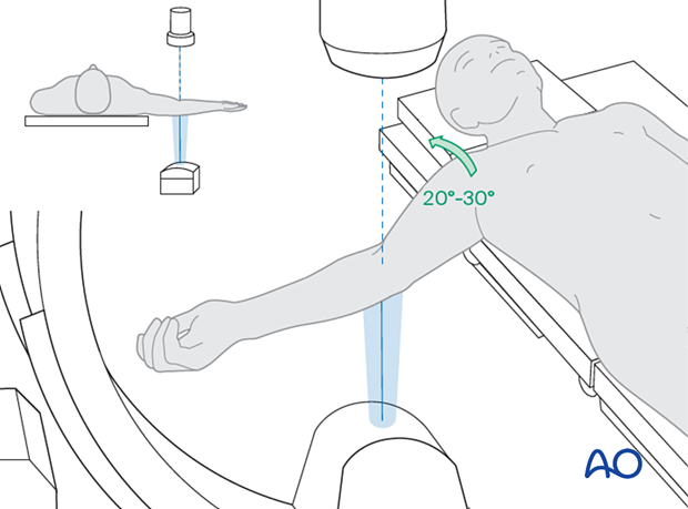 Positioning for optimal AP view PRUJ