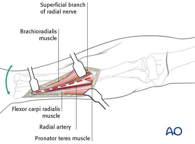 Anterior approach (Henry) to the forearm shaft