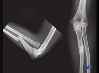 ORIF - Plating for Simple fracture of the ulna, with dislocation of ...