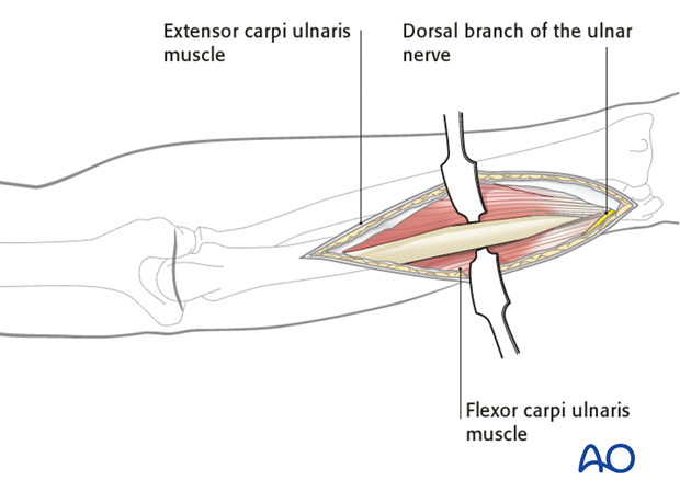 Approach to the ulna
