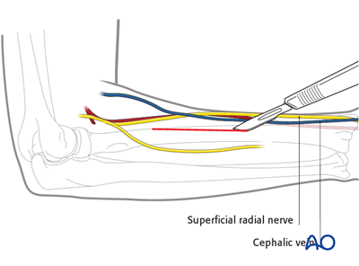 Posterolateral Approach (thompson) To The Forearm Shaft