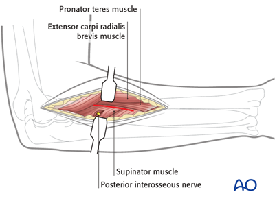 Posterolateral Approach (thompson) To The Forearm Shaft