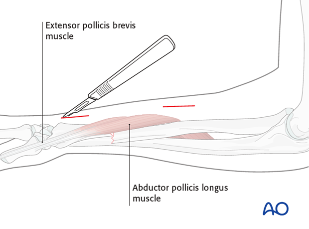 Posterolateral approach (Thompson)