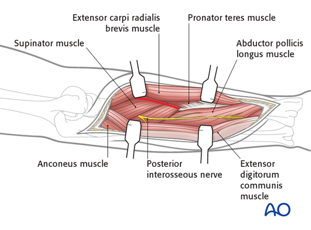 Combined posterior approach to radius and ulna