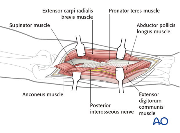 Combined posterior approach to radius and ulna