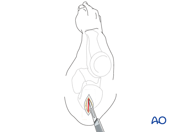 Approach to the ulna for intramedullary nailing