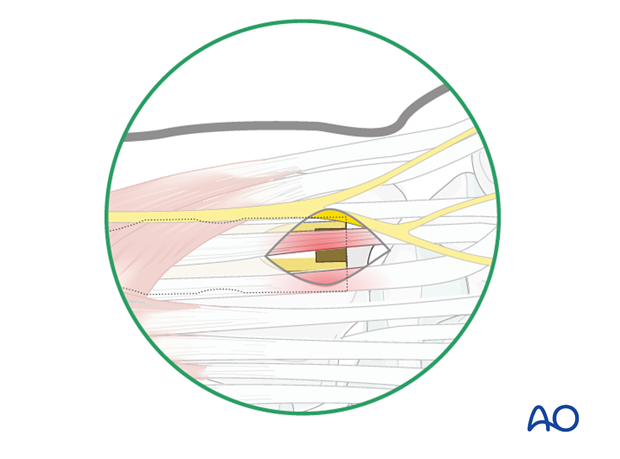 Approaches to the radius for intramedullary nailing