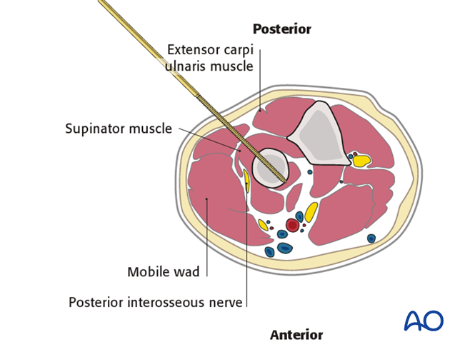 Safe zonesin the forearm for pin placement