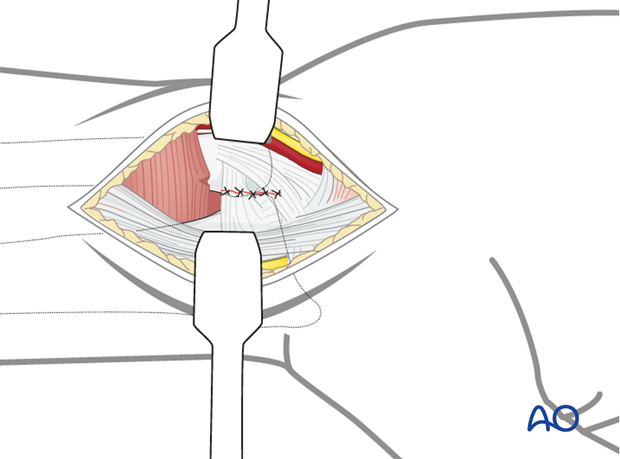 Approaches to the DRUJ (posterior/anterior)