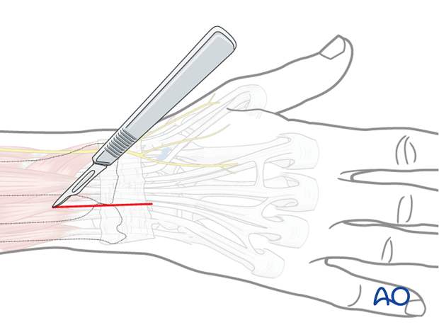 Approaches to the DRUJ (posterior/anterior)