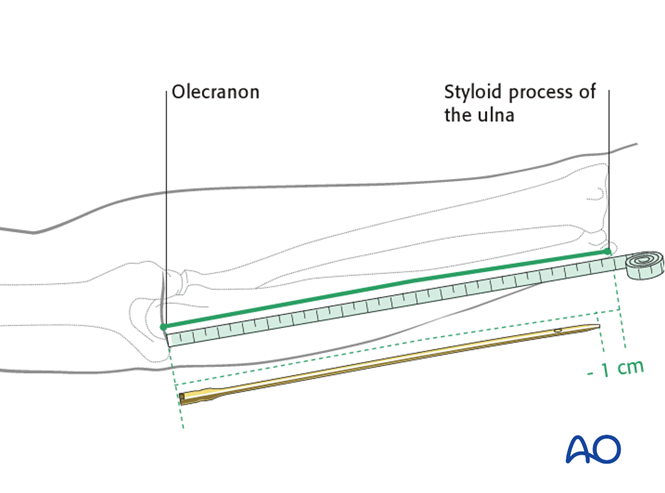 Intramedullary nailing for Multifragmentary, fragmentary segmental ...