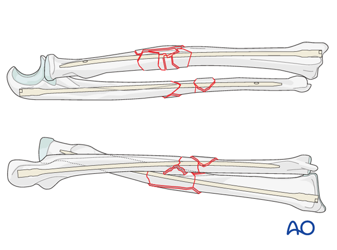 Intramedullary nailing for Multifragmentary, fragmentary segmental ...