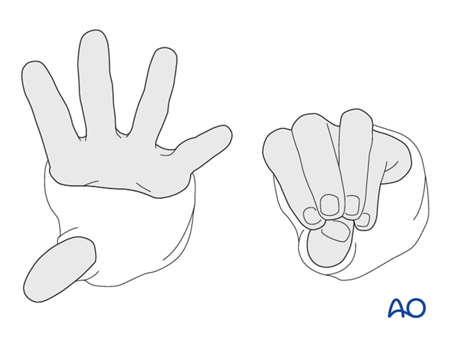 Nonoperative treatment for Transverse simple fracture of the ulna