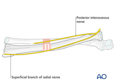 External fixation for Simple fracture of the radius and the ulna