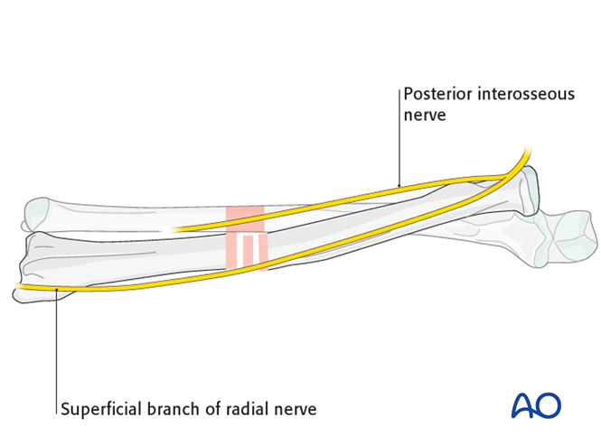 External fixation for Simple fracture of the radius and the ulna