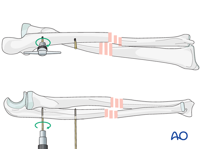 External fixation for Simple fracture of the radius and the ulna