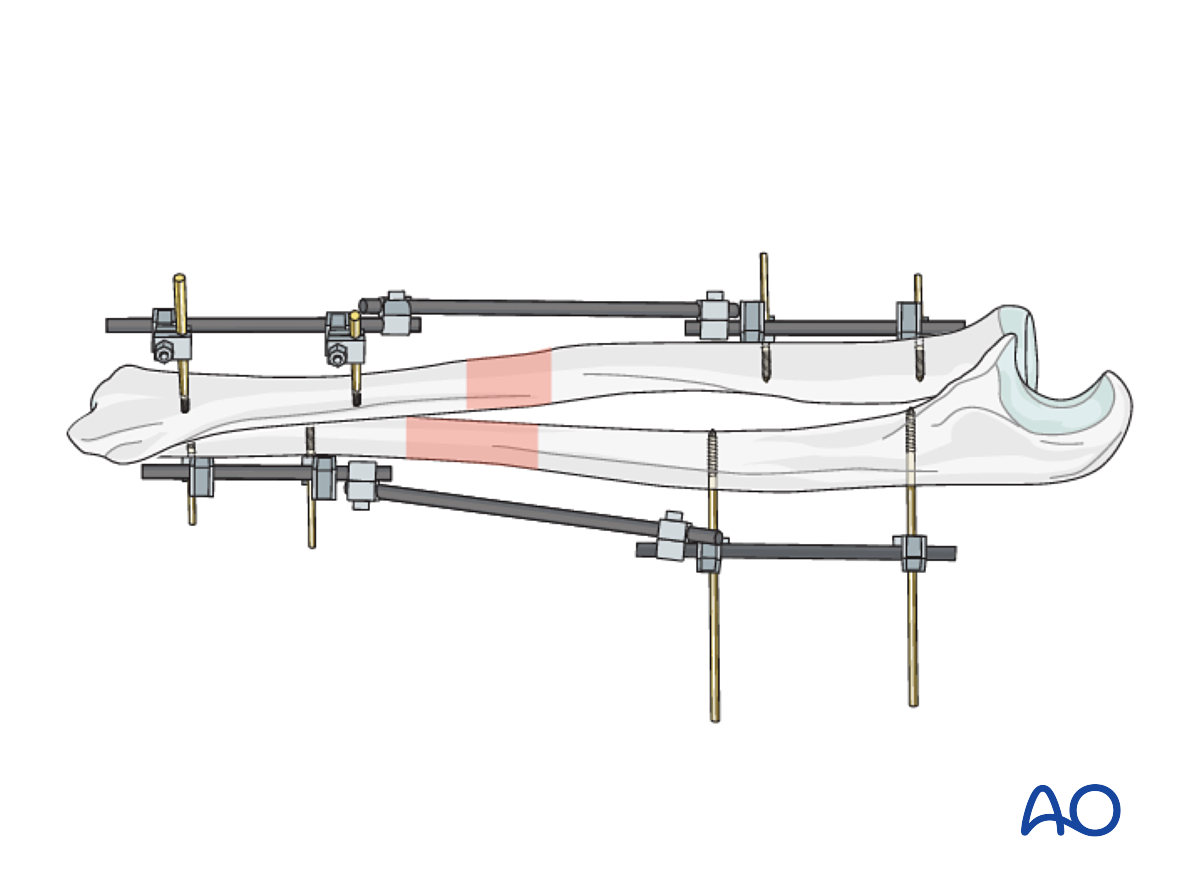 External Fixation For Simple Fracture Of The Radius And The Ulna