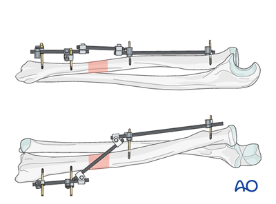 External fixation for Simple fracture of the radius, with dislocation ...