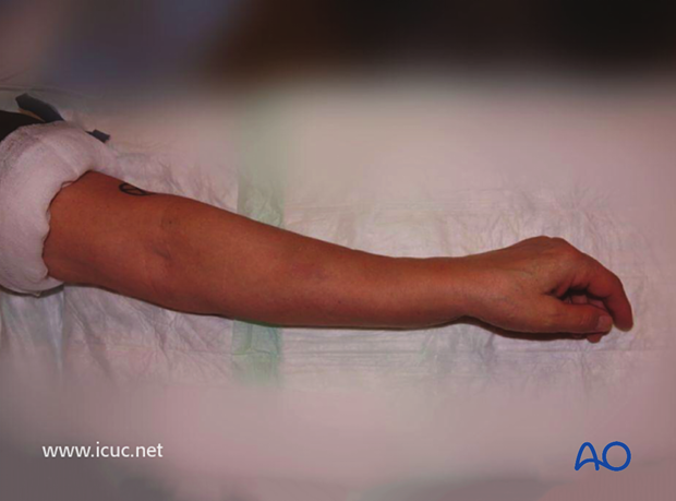 Clinical deformity of unreduced fracture