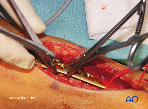 A dorsal contoured LCP is applied carefully to ensure enough bicortical screw fixation will be achieved on either side of the fracture.