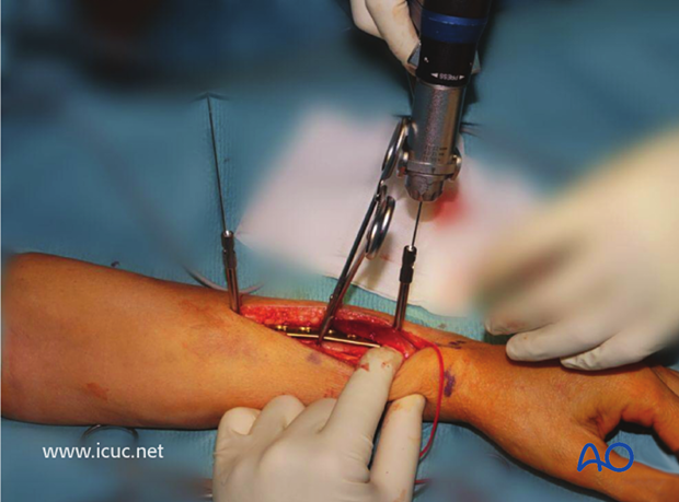 Intraoperative image showing plate has been secured with K-wire in the appropriate location.