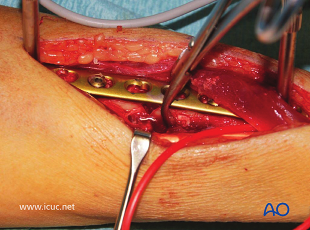 Near perfect reduction of the radial fracture with compression.