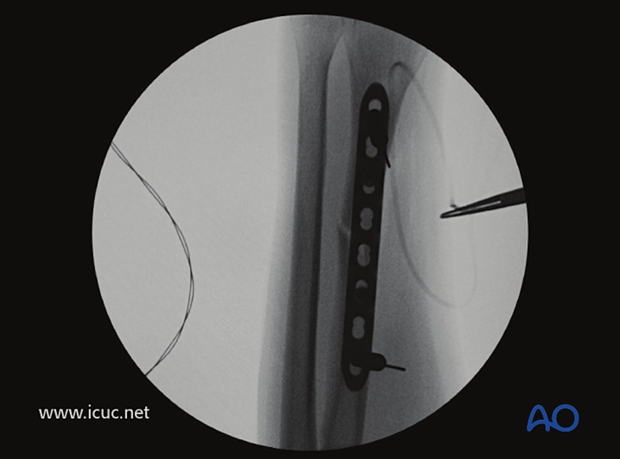 Intraoperative fluoroscopy image showing near perfect reduction. 