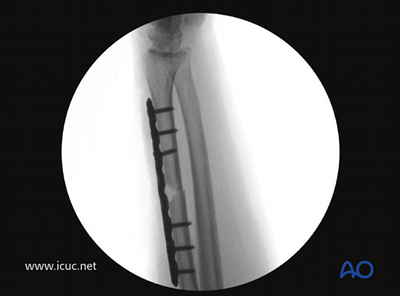 ORIF - Plating for Simple fracture of the radius, with dislocation of ...