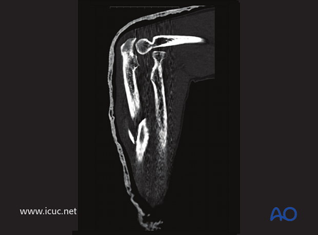 CT of elbow demonstrating anterior radial head dislocation.