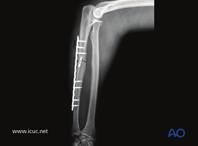 ORIF - Plating for Simple fracture of the ulna, with dislocation of ...