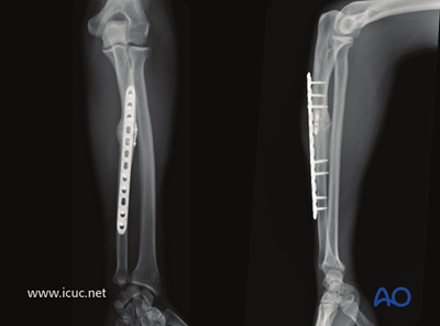 ORIF - Plating for Simple fracture of the ulna, with dislocation of ...