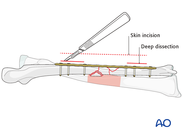 Extent of surgical approach (dissection)